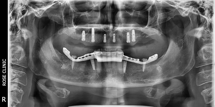 Khách hàng thực hiện dịch vụ All on 6. Bệnh nhân nữ, 46 tuổi được cắm 6 trụ Implants Dentium, kết hợp nâng xoang hở 2 bên.