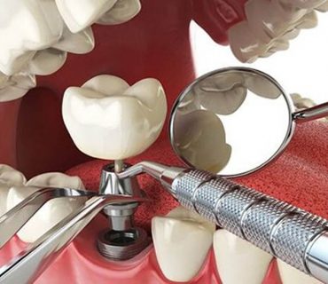 Tìm hiểu về quy trình cấy ghép răng implant