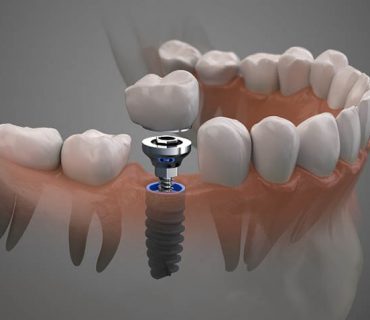 Quá trình trồng răng implant mất bao lâu?