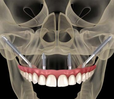 Lợi ích của việc cấy ghép zygomatic Implant