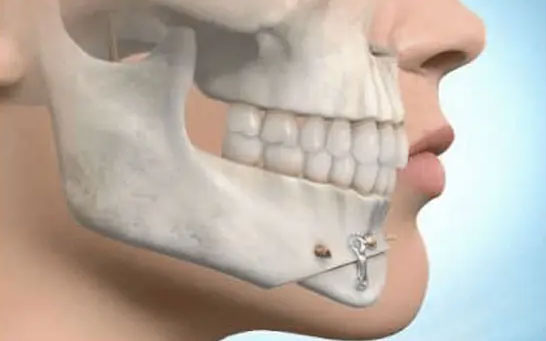 Phẫu Thuật Trượt Cằm