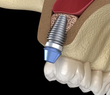 Nâng xoang trong cấy ghép Implant là gì? Kín và Hở khác gì nhau?