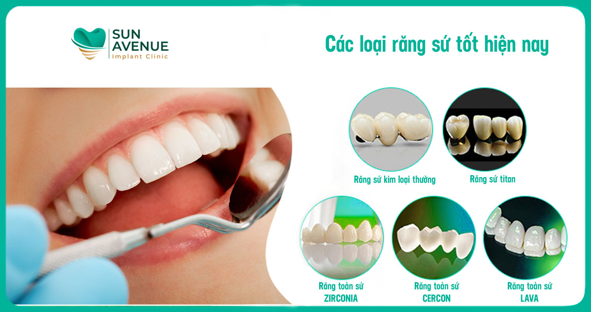 Các loại răng sứ.