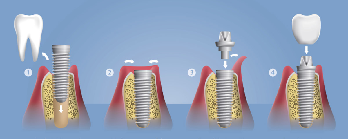 Quy trình implant.