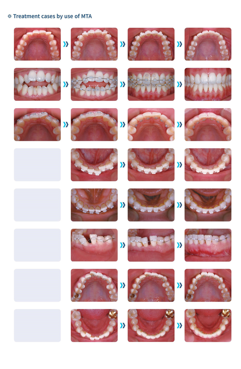 Phương pháp chỉnh răng dùng ống tube.